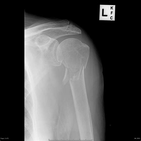 axial compression test humerus fracture|posterior humerus fracture diagram.